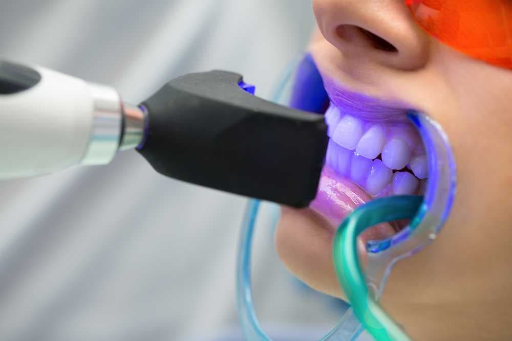 Invisalign: Die unsichtbare Zahnspange für eine diskrete Korrektur