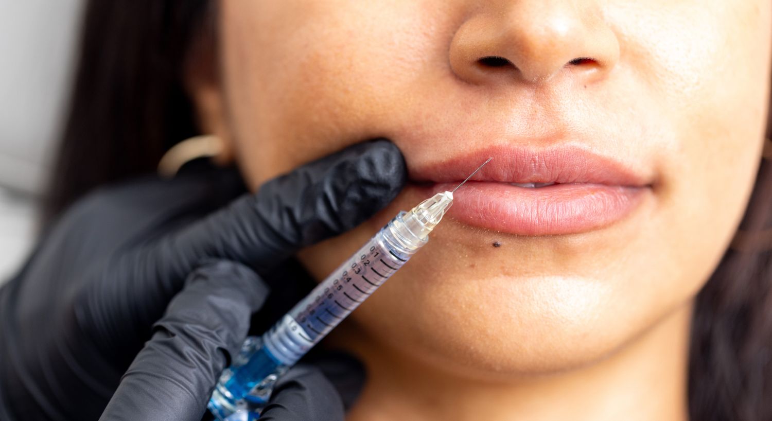 juvederm dermal filler – Qualität und Sicherheit vereint